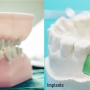 Dentures vs. Implants