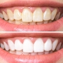 Is teeth whitening safe?