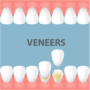 What to know about Dental Veneers?