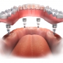Facts about Dental Implant Recovery Process